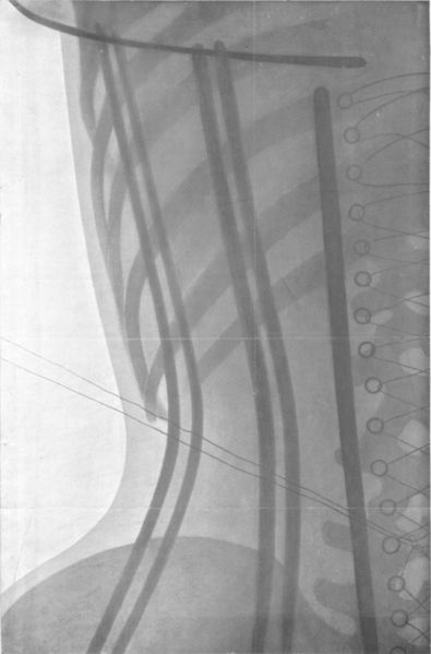 Radiographie (grandeur naturelle)du Corset Ligne(Vue de dos)