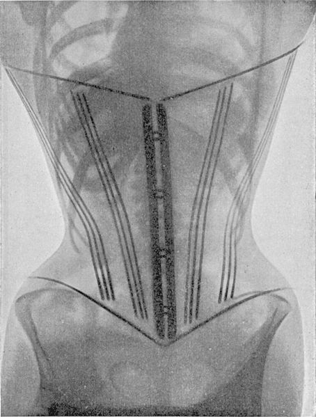 Padiographie du corset cambré de devant
