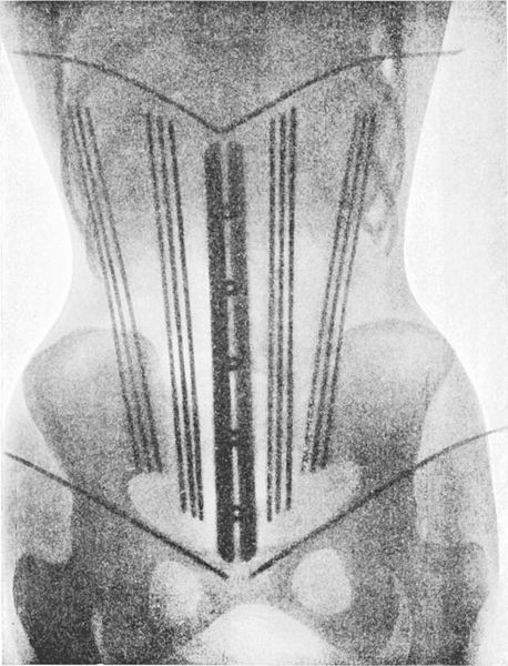Radiographie du corset Ligne de devant