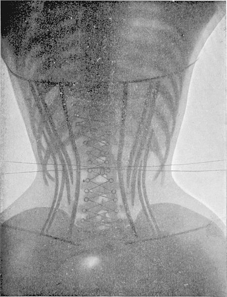 Padiographie du corset cambré (dos)
