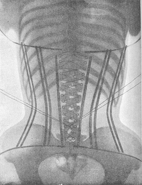 Padiographie du corsetLigne