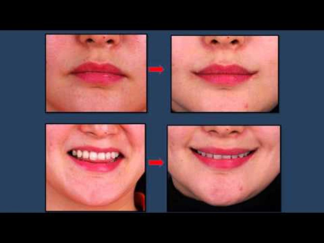 beauté bouche_lift_Korea_plastic_surgery_