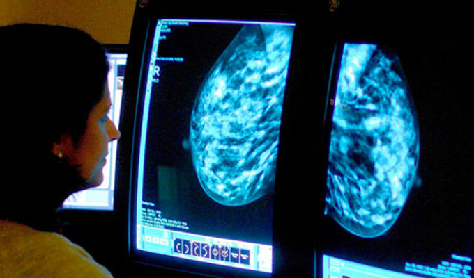 cancer-du-sein-étude-santé