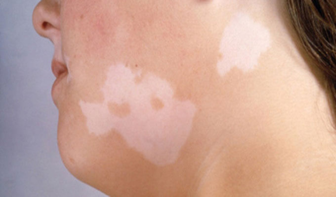 santé--vitiligo2