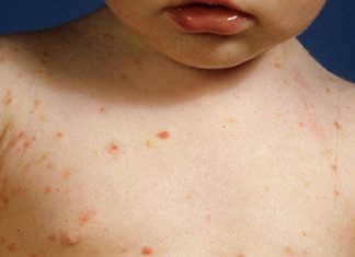 Des cas de gale signalés chez des écoliers à Bizerte